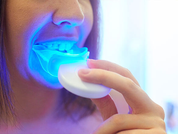 tooth whitening system