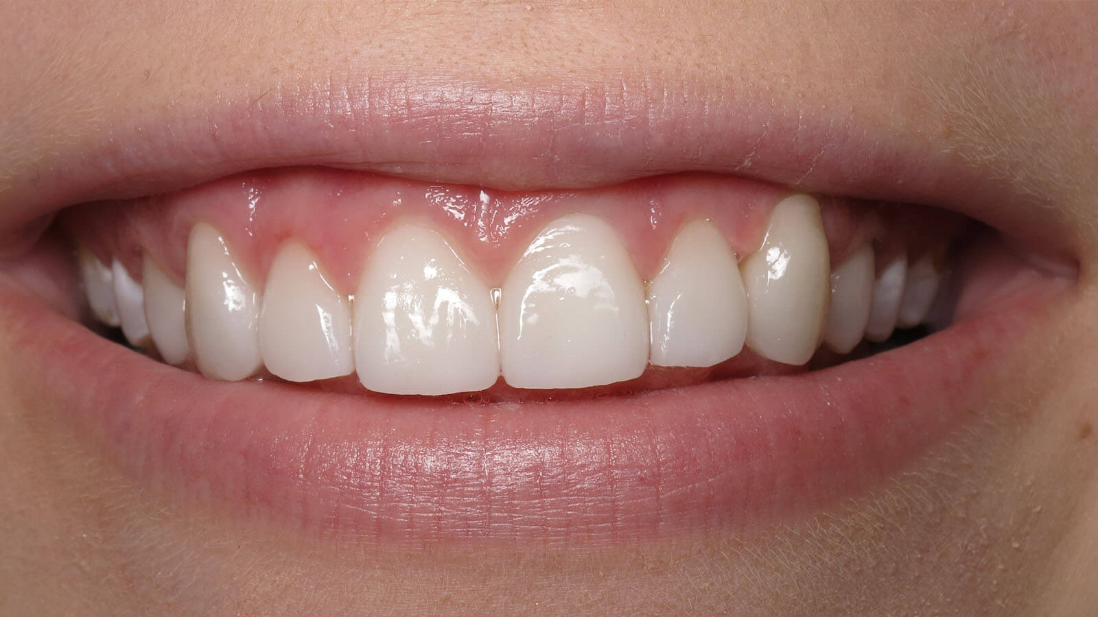 close up of teeth after tooth whitening
